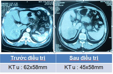 Ảnh chụp cắt lớp vi tính đa dãy trước và sau điều trị một tháng
