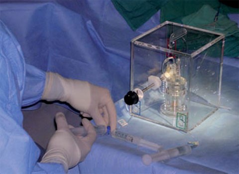 Tiến hành bơm hạt vi cầu gắn Y-90 qua catheter vào khối u gan.